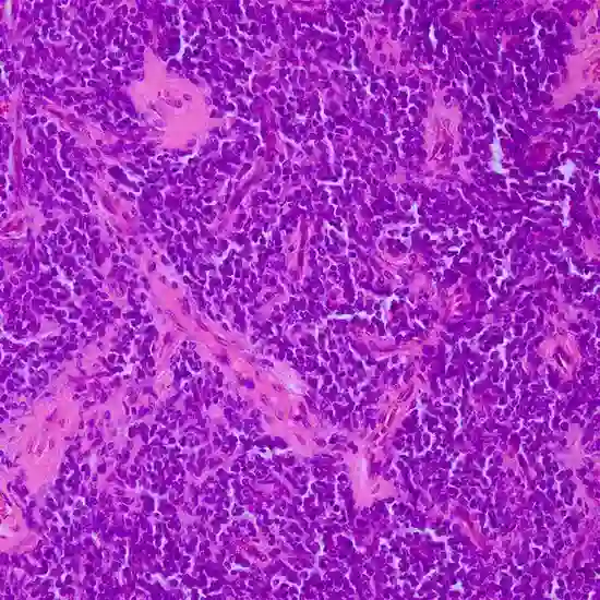primitive neuroectodermal tumor